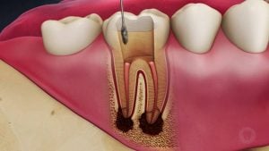 درمان ریشه ، بهترین دندانپزشک در اصفهان ، ایمپلنت دندان در اصفهان ، کامپوزیت دندان در اصفهان ، لمینت دندان در اصفهان