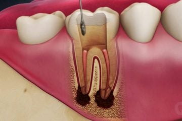 درمان ریشه ، بهترین دندانپزشک در اصفهان ، ایمپلنت دندان در اصفهان ، کامپوزیت دندان در اصفهان ، لمینت دندان در اصفهان