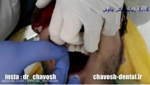مراحل چسباندن لمینت دندان در اصفهان