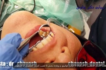 عصب کشی تخصصی با استفاده از اپکس لوکیتور و روتاری در اصفهان