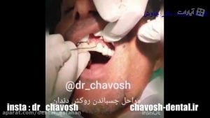 مراحل چسباندن روکش دندان در اصفهان