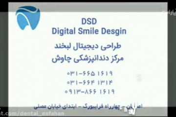 اصلاح طرح لبخند به روش DSD - دندانپزشکی زیبایی دندان چاوش در اصفهان