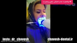 آفیس بلیچینگ -بلیچینگ و سفید کردن دندان در اصفهان