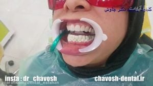 بلیچینگ دندان های فک پایین در اصفهان برای همرنگ شدن با رنگ کامپوزیت فک بالا