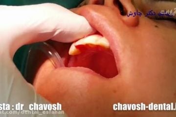 عصب کشی تخصصی دندان در اصفهان