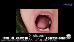 کاشت و چسباندن روکش 5 واحد ایمپلنت دندان در اصفهان - دندانپزشکی زیبایی چاوش