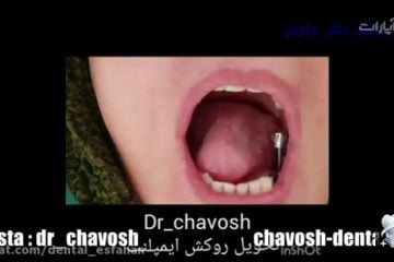 کاشت و چسباندن روکش 5 واحد ایمپلنت دندان در اصفهان - دندانپزشکی زیبایی چاوش