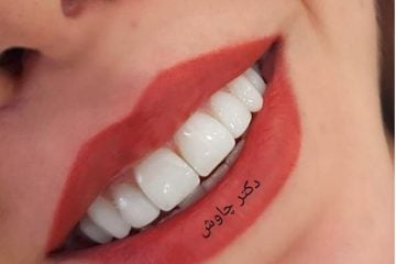 بهترین دکتر کامپوزیت دندان در اصفهان