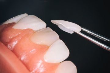 مراحل لمینت دندان در اصفهان