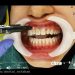 آفیس بلیچینگ مطب دندان در اصفهان - سفید کردن دندان در مطب اصفهان